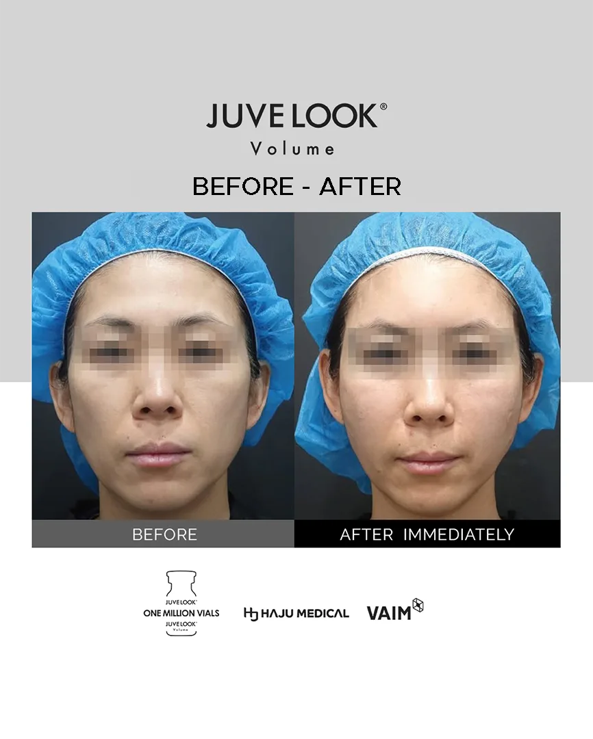 Foto sebelum dan sesudah Juvelook Volume dari depan, langsung setelah treatment
